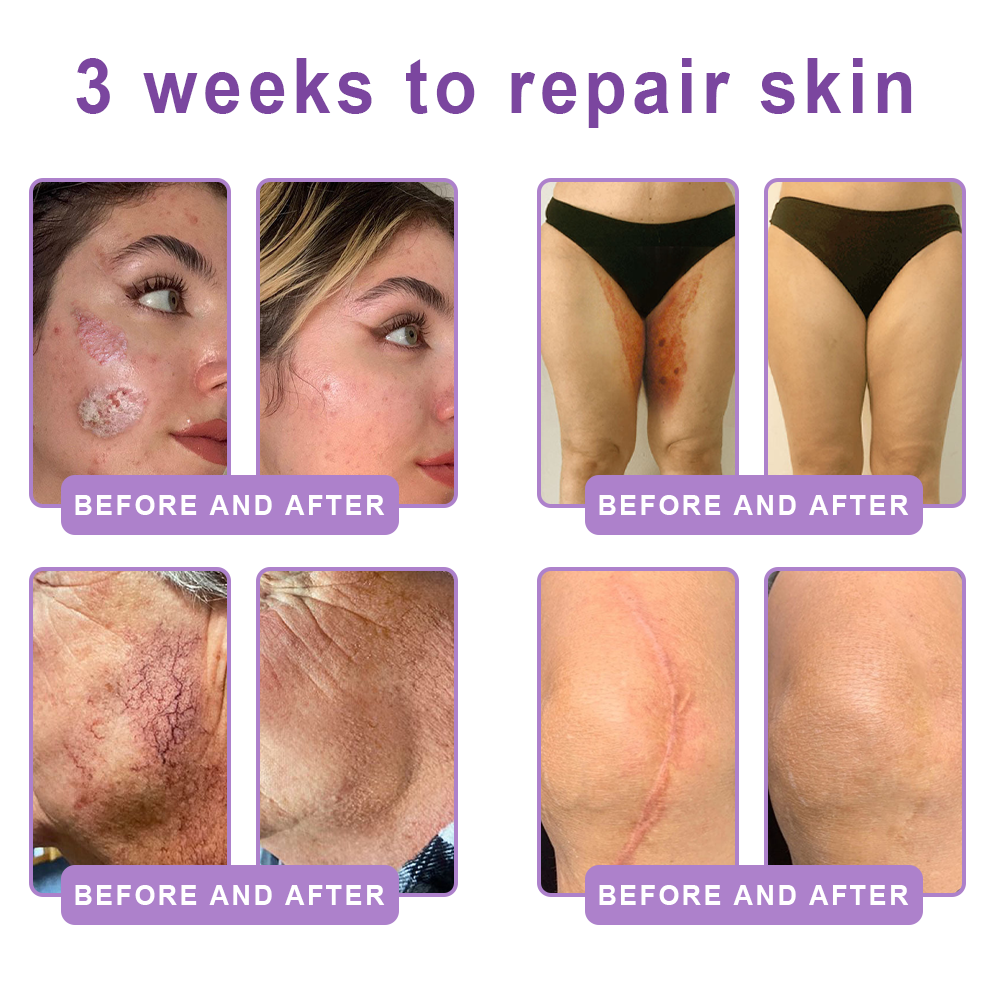 💎FDA Official: Vitalisys® PDRN Multi-Peptide Massaging Body Roller Cream- Anti-aging, Hydrating, Skin Firming & Lifting, Skin Repair, Even Tone, Acne and Dark Spot Treatment, Wart and Mole Removal, and Psoriasis Relief.