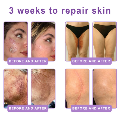 💎FDA Official: Vitalisys® PDRN Multi-Peptide Massaging Body Roller Cream- Anti-aging, Hydrating, Skin Firming & Lifting, Skin Repair, Even Tone, Acne and Dark Spot Treatment, Wart and Mole Removal, and Psoriasis Relief.